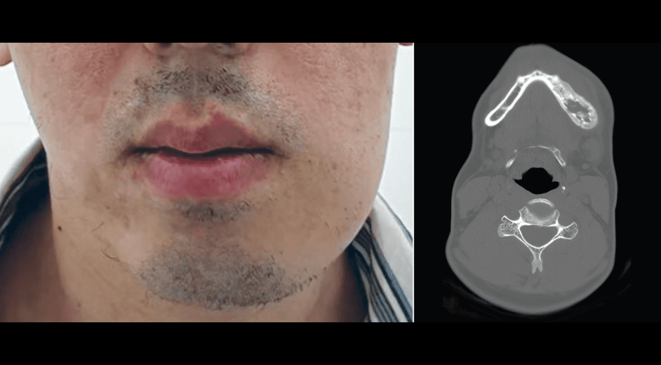 Редкий случай синдрома SAPHO у пациента из Китая: как болезнь получила новое объяснение